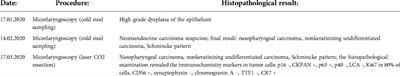 Lymphepithelial carcinoma - a rare tumor of the larynx. Case Report